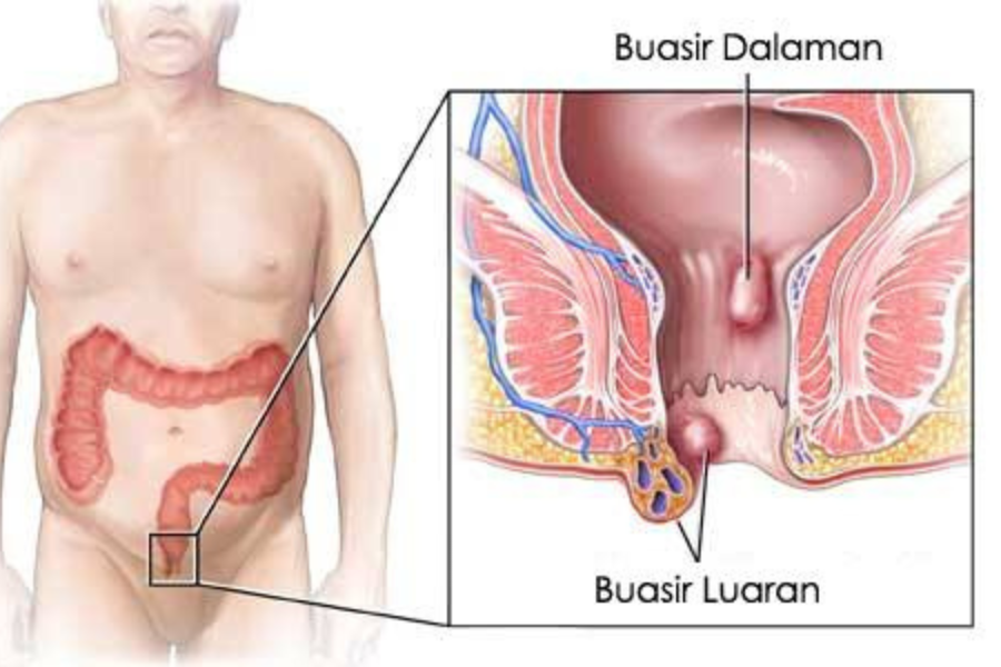 Buasir merupakan gejala pembengkakan dan radang pada saluran darah di sekeliling lubang dubur atau di bahagiah saluran dubur.