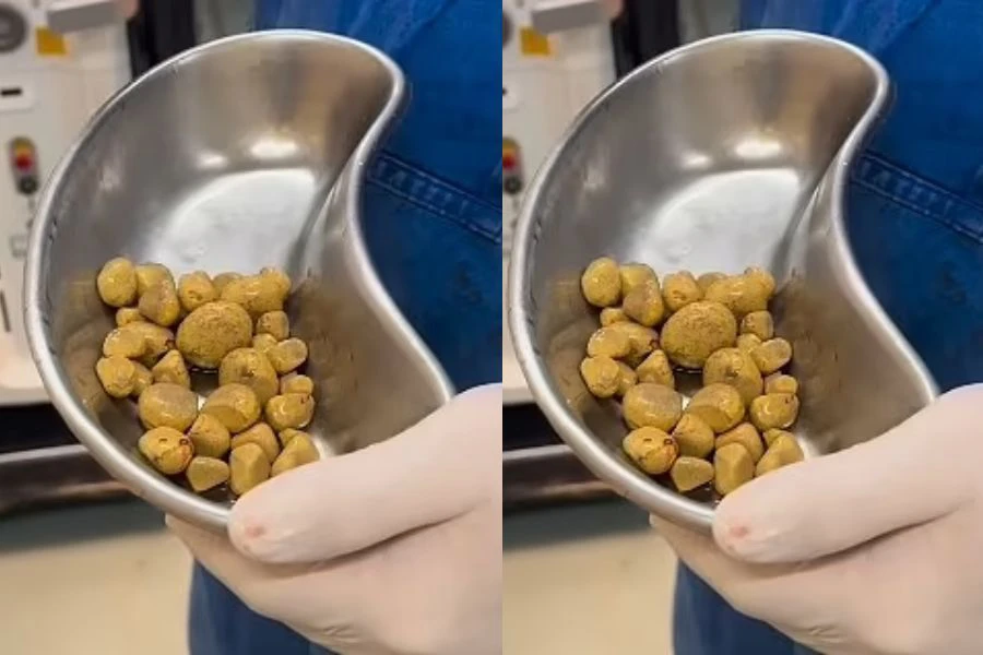 Sebanyak 35 batu karang dikeluarkan dari pundi kencing pesakit akibat tabiat meminum tiga liter air coke setiap hari.