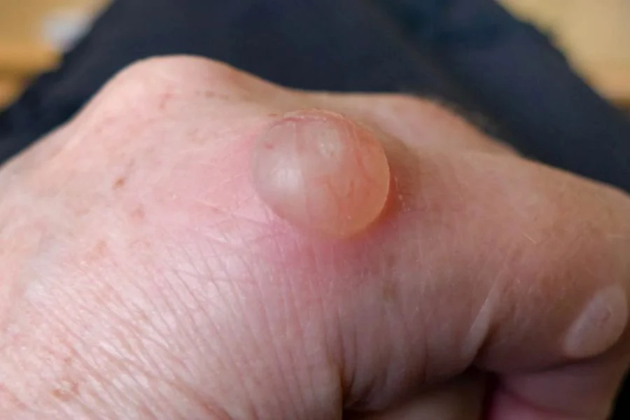 Jangan pecahkan lepuh kerana boleh dijangkit bakteria.