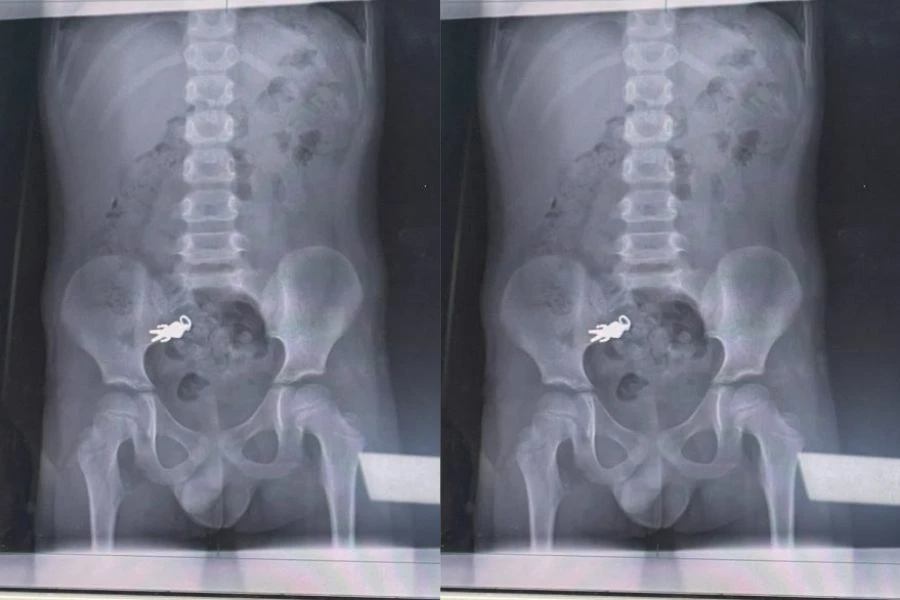 Hasil x-ray menunjukkan 'keychain' berada pada bahagaian usus.