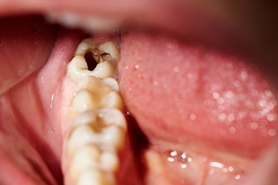 Tabiat itu mengakibatkan gigi berlubang.