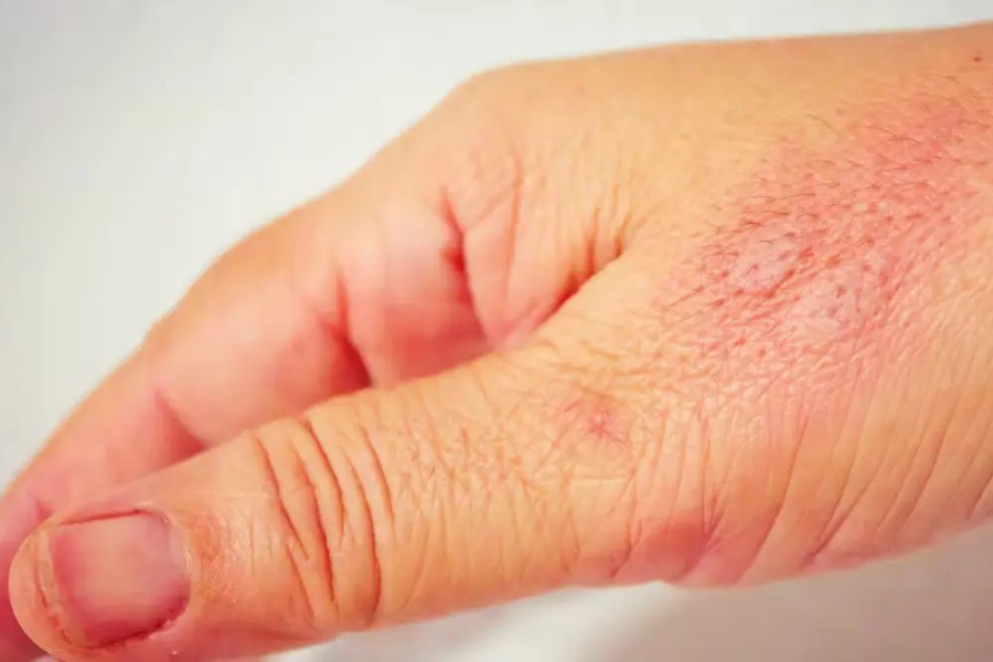 Kandungan xanthone dalam asam keping juga berpotensi mengatasi keradangan dalam badan.