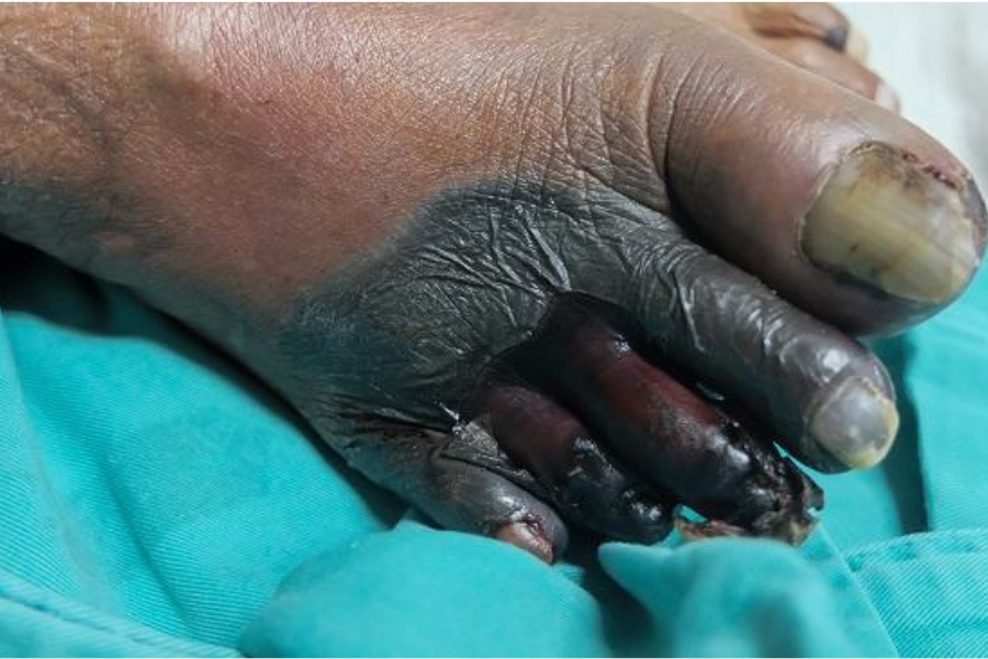 Luka yang kecil menjadi lebih besar disebabkan masalah daibetes yang dialami.