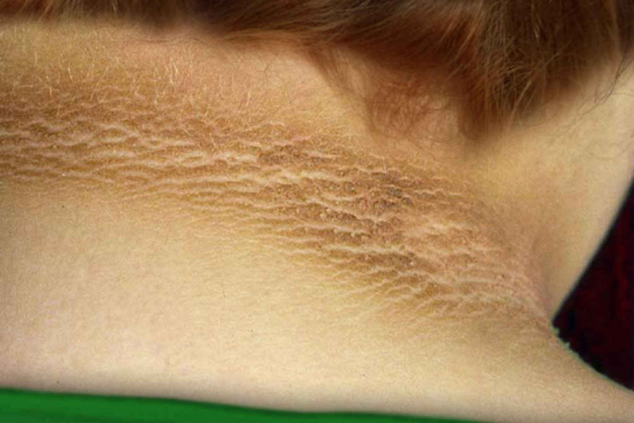 Kulit yang mengalami perubahan warna yang gelap pada lipatan badan.