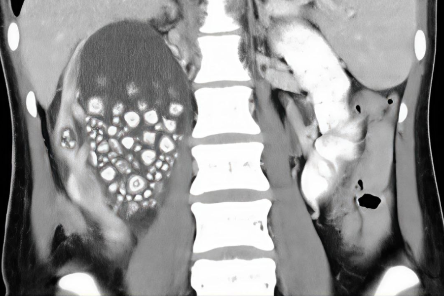 Hasil imbasan ultrabunyi mendapati terdapat ketulan batu karang terbentuk dalam tubuh seorang wanita akibat pegambilan minuman manis yang tinggi.
