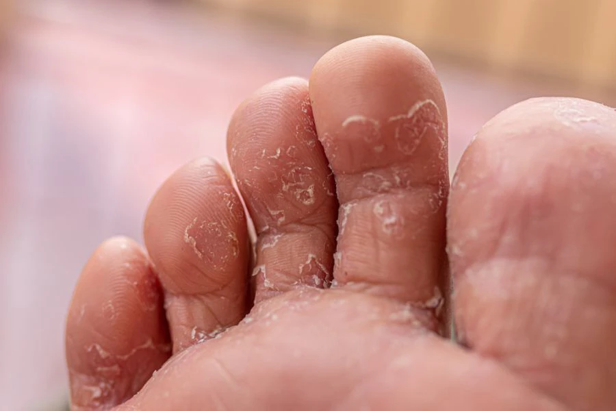 Rendaman kaki menggunakan cuka epal boleh membantu memberi keselesaan dan mengurangkan kerengsaan.