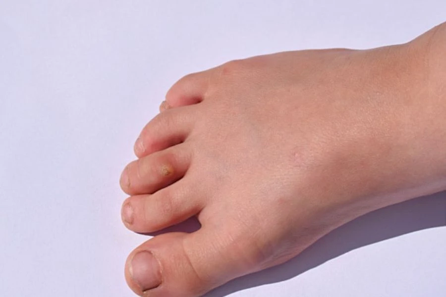 Cuka epal bertindak sebagai agen pengelupasan ringan yang boleh membantu menanggalkan sel kulit mati.