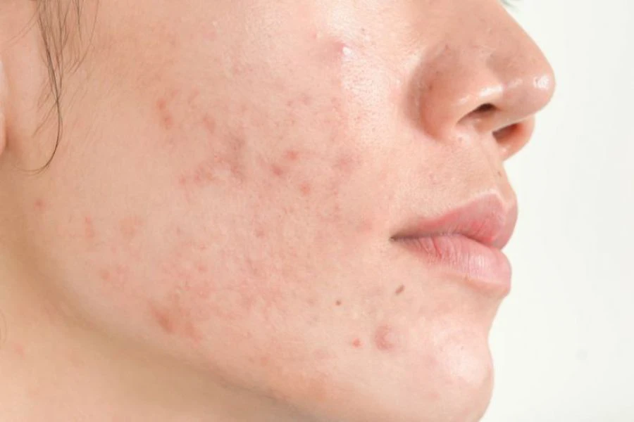 Kandungan mineral dalam tempe membantu melawan radikal bebas yang membantu menyokong kesihatan kulit.