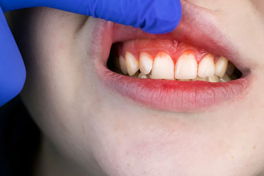 Masalah jangkitan gigi dan gusi antara punca biasa mulut berbau.