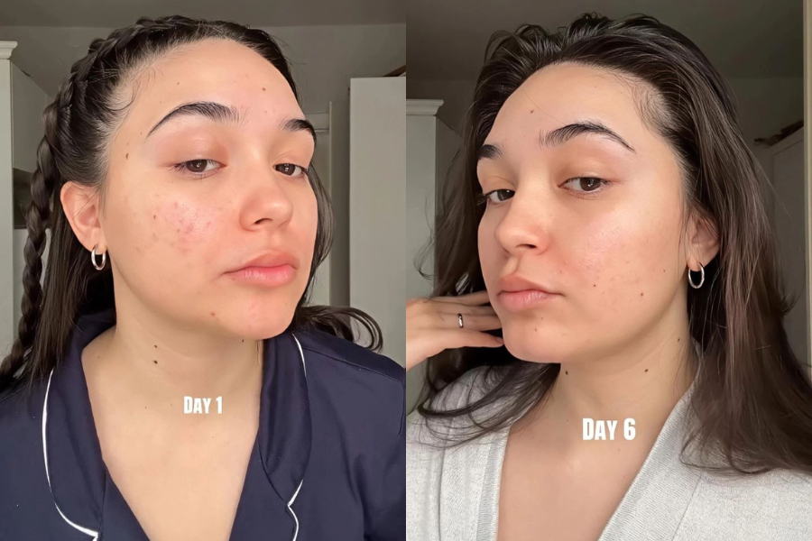 Perbandingan kulit selepas mengamalkan trend 'morning shot' selepas enam hari.